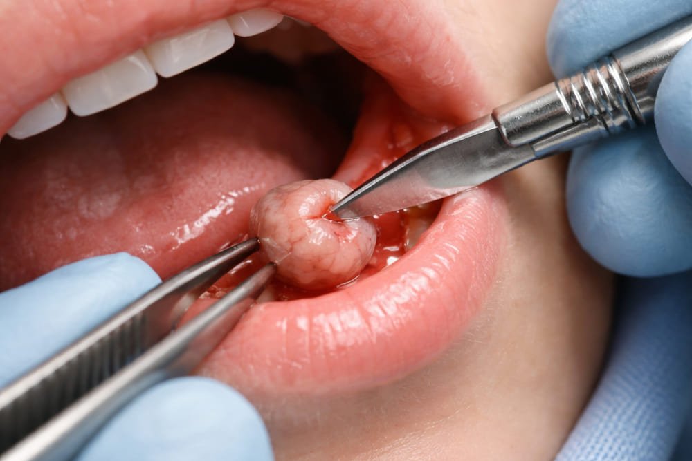 Biopsia de glándula salival menor